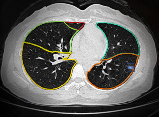 肺結節(jié)ct圖像輔助檢測軟件sensecare-lung