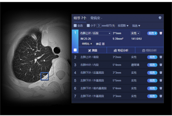 肺結節(jié)ct圖像輔助檢測軟件uai-pioneerchest聯(lián)影